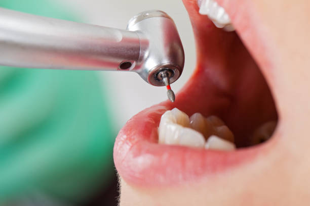 Best Emergency Wisdom Teeth Removal in East Bethel, MN